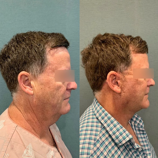 Gangnam Facelift: What Makes the Difference for Long-Lasting Results? 사진 7