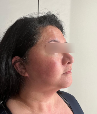 Gangnam Facelift: What Makes the Difference for Long-Lasting Results? 사진 9