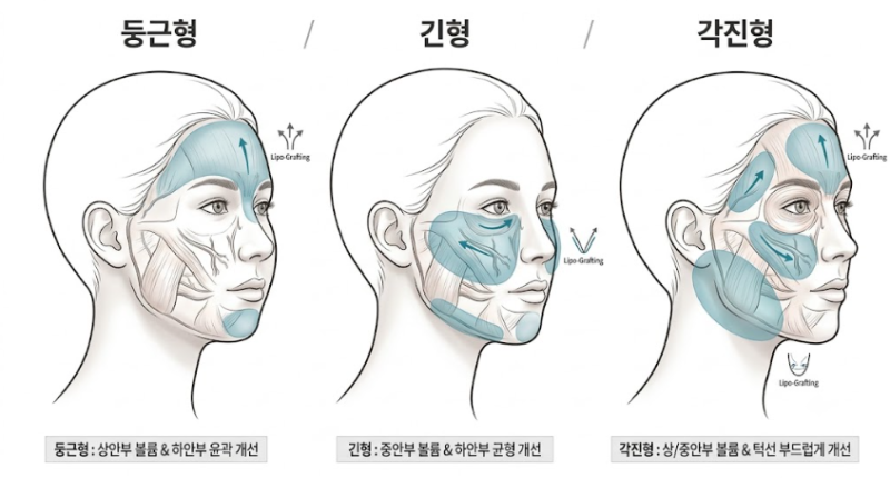 ما هي المعايير التي ترفع معدل بقاء دهون الوجه المزروعة في عيادة جراحة التجميل في جانجنام؟ 사진 8