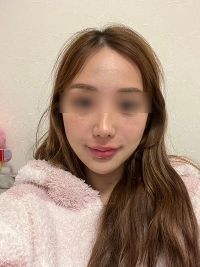 شد الوجه بالخيوط في عيادة جراحة التجميل الشهيرة في جانجنام، معرفة هذه المعلومات قبل الإجراء تسهل الاختيار 사진 10