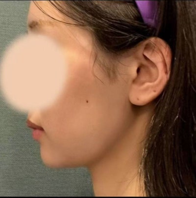 شد الوجه بالخيوط في عيادة جراحة التجميل الشهيرة في جانجنام، معرفة هذه المعلومات قبل الإجراء تسهل الاختيار 사진 14