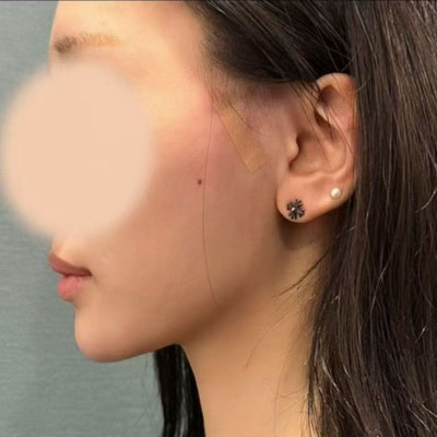 شد الوجه بالخيوط في عيادة جراحة التجميل الشهيرة في جانجنام، معرفة هذه المعلومات قبل الإجراء تسهل الاختيار 사진 15