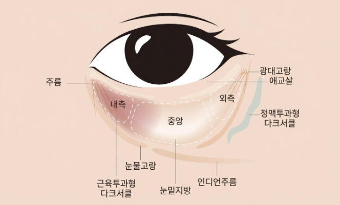 Gangnam Under-Eye Fat Repositioning Surgery: Will All Dark Circles Disappear? 사진 9