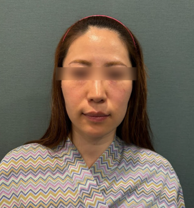 Seoul Facial Wrinkle Lifting: What's the Secret to Looking Younger Than Your Age? 사진 4