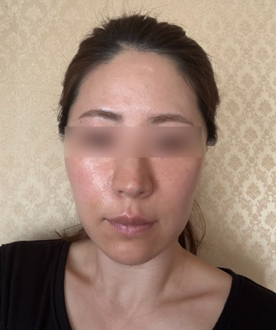 Seoul Facial Wrinkle Lifting: What's the Secret to Looking Younger Than Your Age? 사진 5