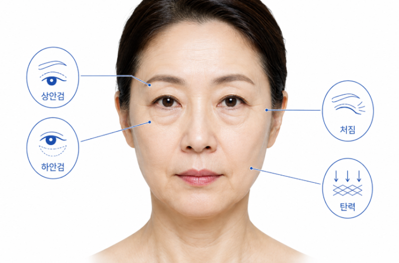 중년눈수술 고민이라면? 상안검·하안검과 안면거상의 차이