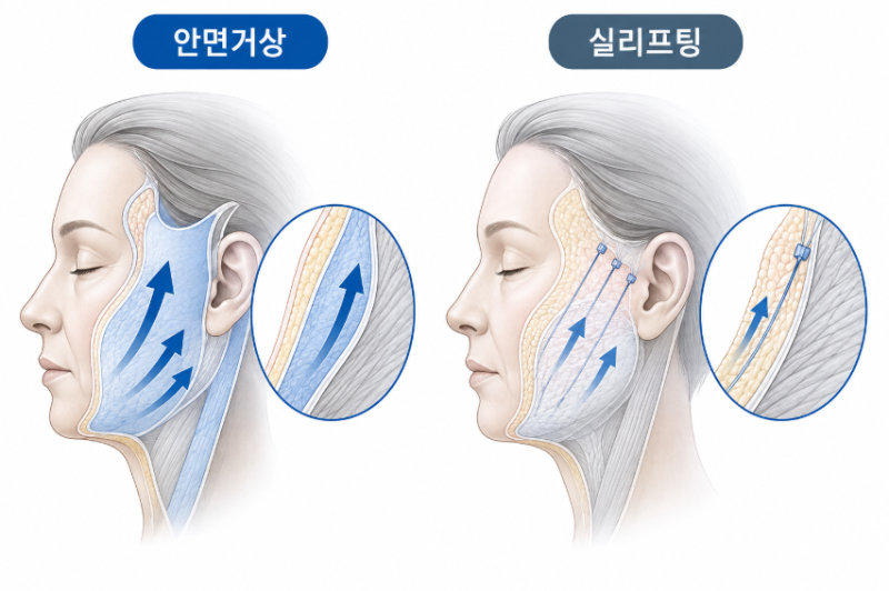 중년눈수술 고민이라면? 상안검·하안검과 안면거상의 차이 사진 9
