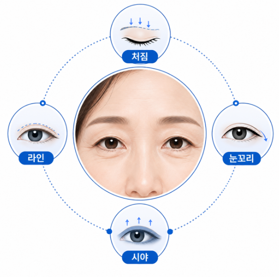 50대 상안검, 쌍꺼풀수술과 무엇이 다를까요? 사진 7