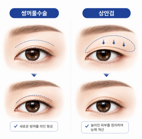 50대 상안검, 쌍꺼풀수술과 무엇이 다를까요? 사진 5