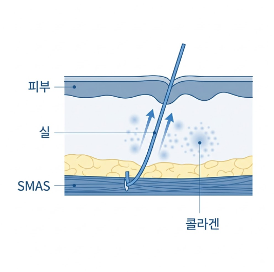강남 실리프팅 잘하는곳, 후회 없는 선택을 위한 실리프팅 가이드 사진 3