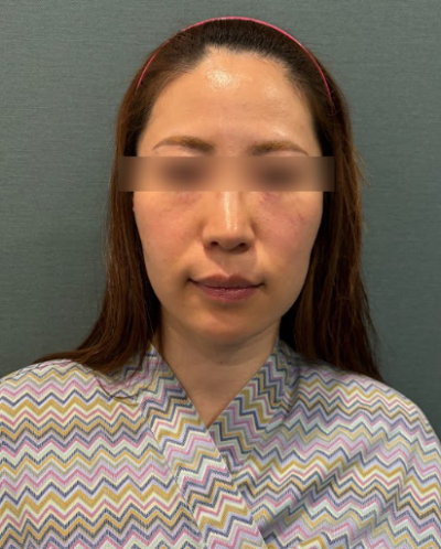 압토스실리프팅, 일반 실리프팅과 뭐가 다를까요? 사진 10