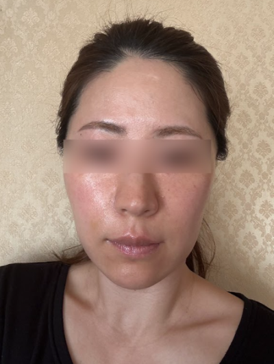압토스실리프팅, 일반 실리프팅과 뭐가 다를까요? 사진 11