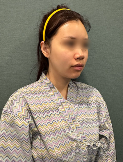 서울 실리프팅잘하는곳 알아본다면? 실리프팅 종류와 특징 총정리 사진 9