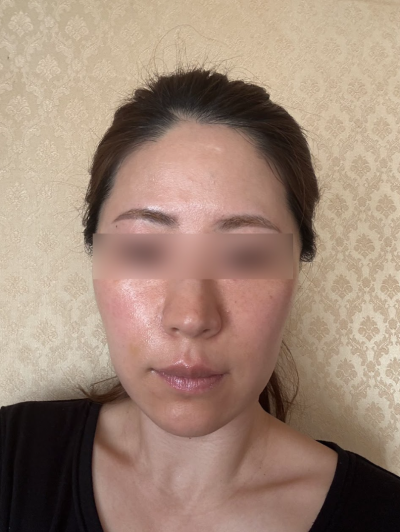 강남 실리프팅 유지기간, 1년 이상 유지될 수 있을까요? 사진 8