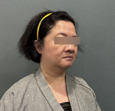 안면거상술, 너무 일찍 받으면 나중에 후회할까요? 사진 7
