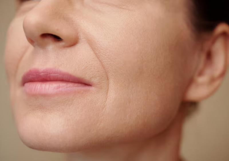 Thread Lift untuk Kerutan Garis Senyum, Seberapa Jauh Garis Senyum yang Mendalam Dapat Diperbaiki? 사진 2