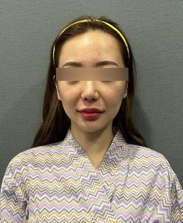Thread Lift untuk Kerutan Garis Senyum, Seberapa Jauh Garis Senyum yang Mendalam Dapat Diperbaiki? 사진 7