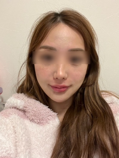 Thread Lift untuk Kerutan Garis Senyum, Seberapa Jauh Garis Senyum yang Mendalam Dapat Diperbaiki? 사진 8