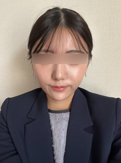안티에이징수술, 리프팅 시술만으로 부족할 때 고려해야 할까요? 사진 7