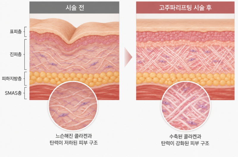 안티에이징수술, 리프팅 시술만으로 부족할 때 고려해야 할까요?