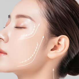 민트실리프팅 12줄, 8줄·10줄과 효과 차이가 클까요? 사진 4