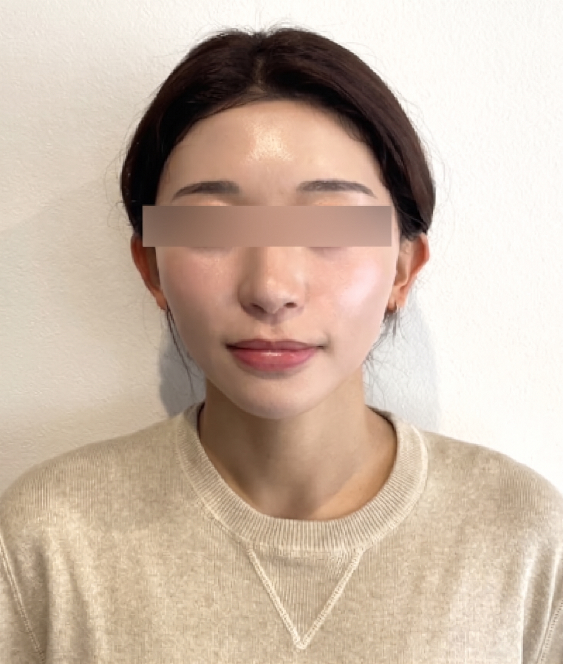 ミントリフトの持続期間、ウルセラ・インモード・シュリンクより長持ちする？ 사진 7