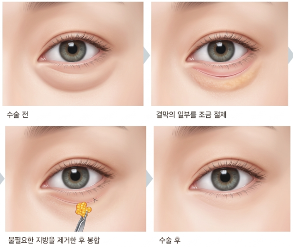 중년하안검, 눈밑이 처지고 피곤해 보인다면 확인해보세요 사진 4