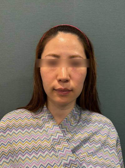 땅콩형얼굴, 살이 빠져서 생긴 걸까요? 원인부터 확인하세요 사진 7