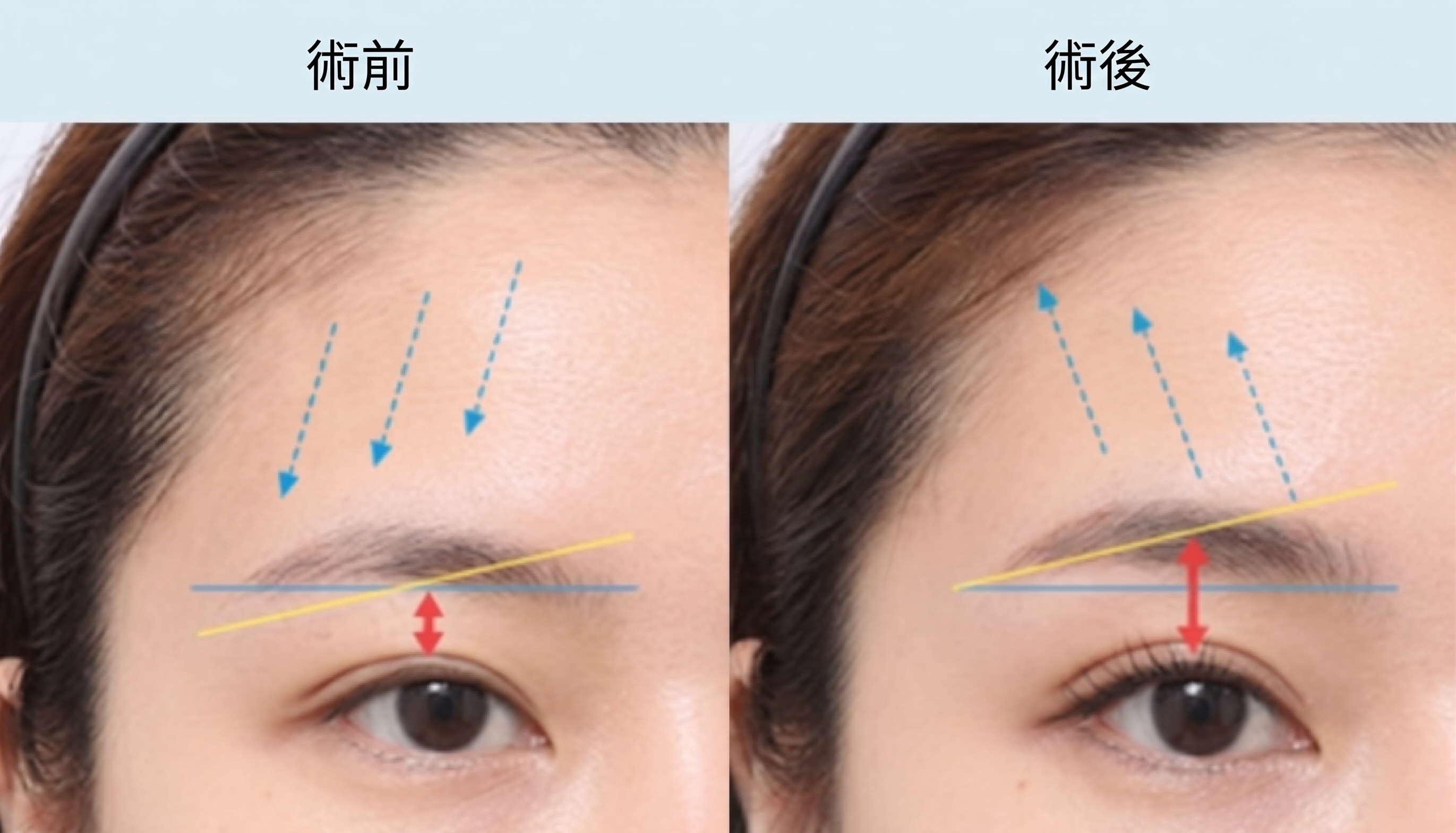 眼皮下垂，提拉與手術該選擇哪一種？ 사진 8