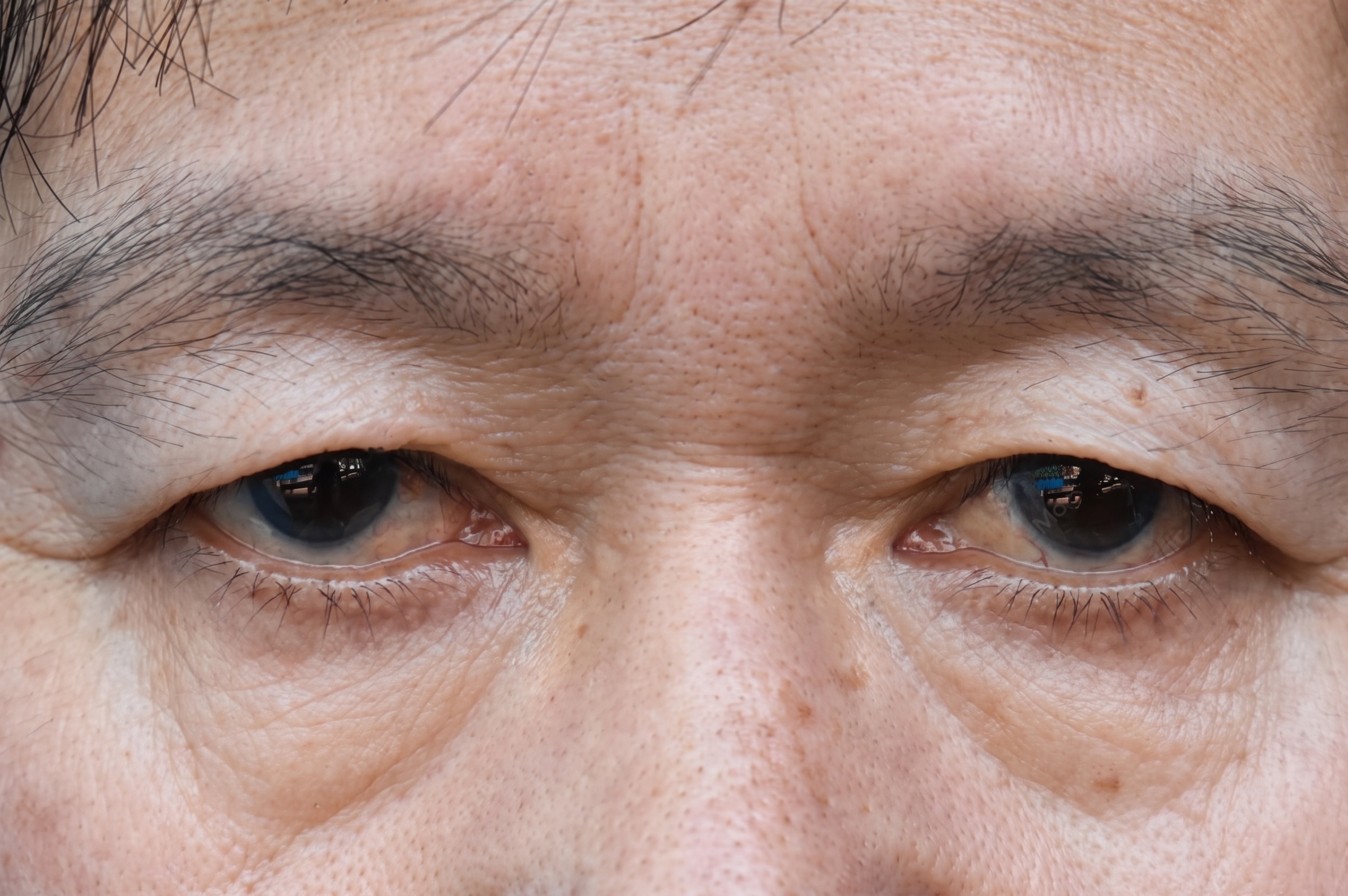 眼瞼下垂手術、まぶたが重く疲れて見えるなら原因から確認を 사진 5