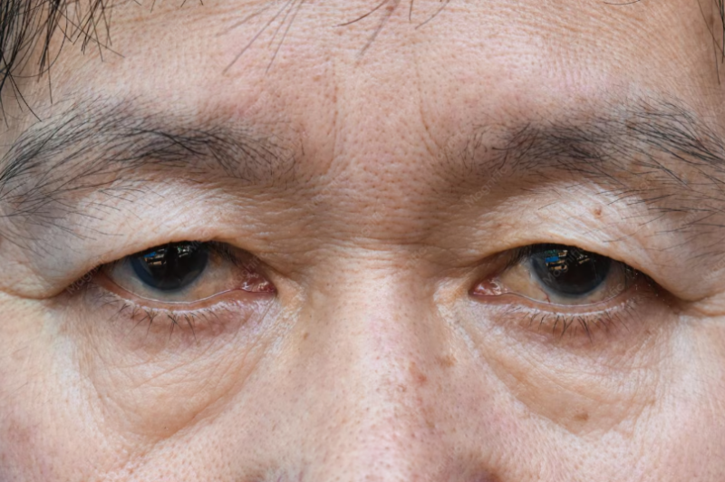 안검하수술, 눈이 무겁고 피곤해 보인다면 원인부터 사진 5