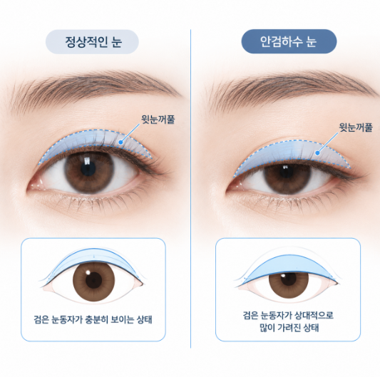 안검하수눈매교정, 쌍꺼풀수술과 무엇이 다를까? 사진 3