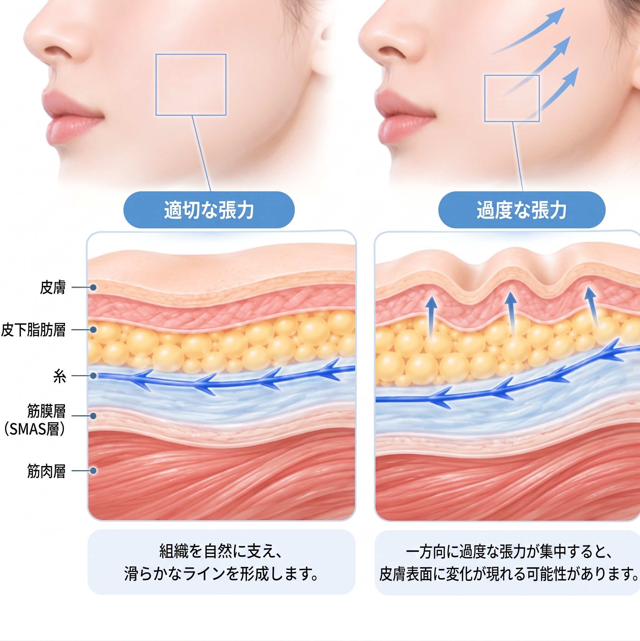 糸リフトの副作用、腫れや内出血だけだと思っていませんか?施術前に知っておくべきこと 사진 6