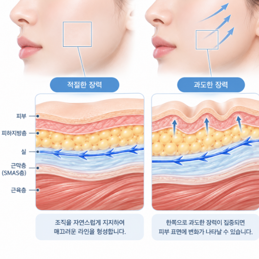 실리프팅부작용, 붓기·멍만 생각했다면? 시술 전 알아야 할 것 사진 6