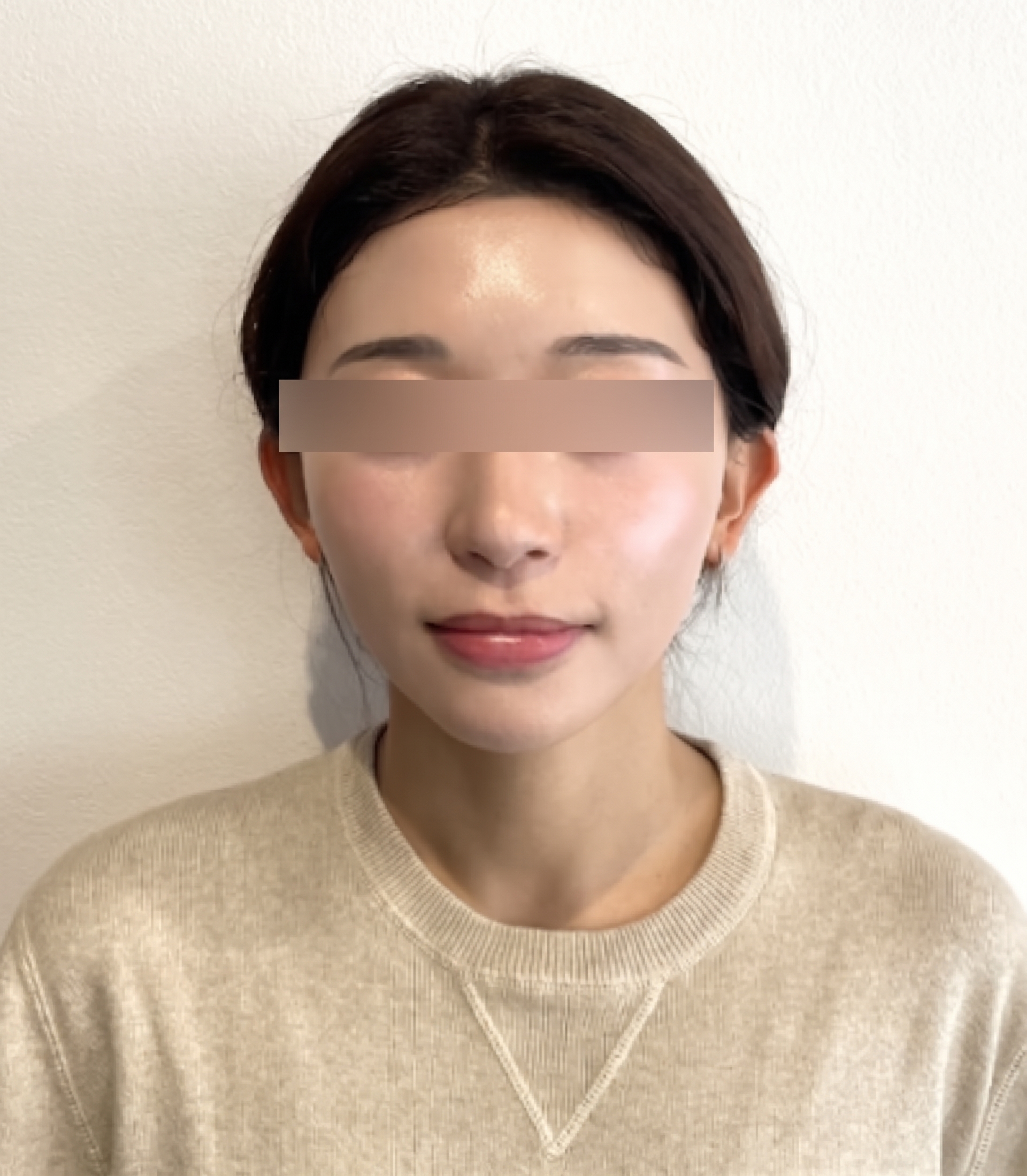 埋線拉提副作用只想到腫脹和瘀青？術前必須了解的要點 사진 10