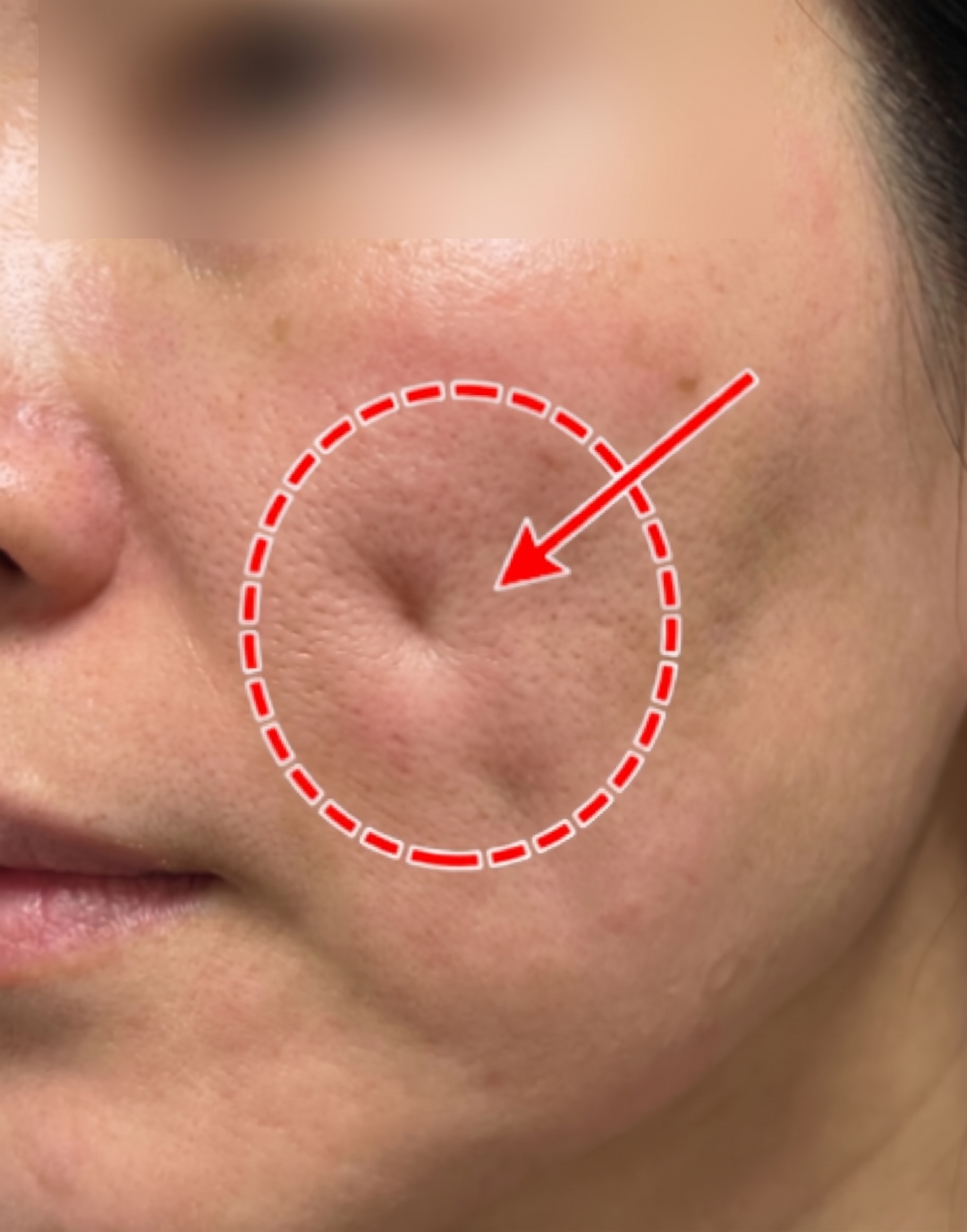 糸リフトの副作用、腫れや内出血だけだと思っていませんか?施術前に知っておくべきこと 사진 5