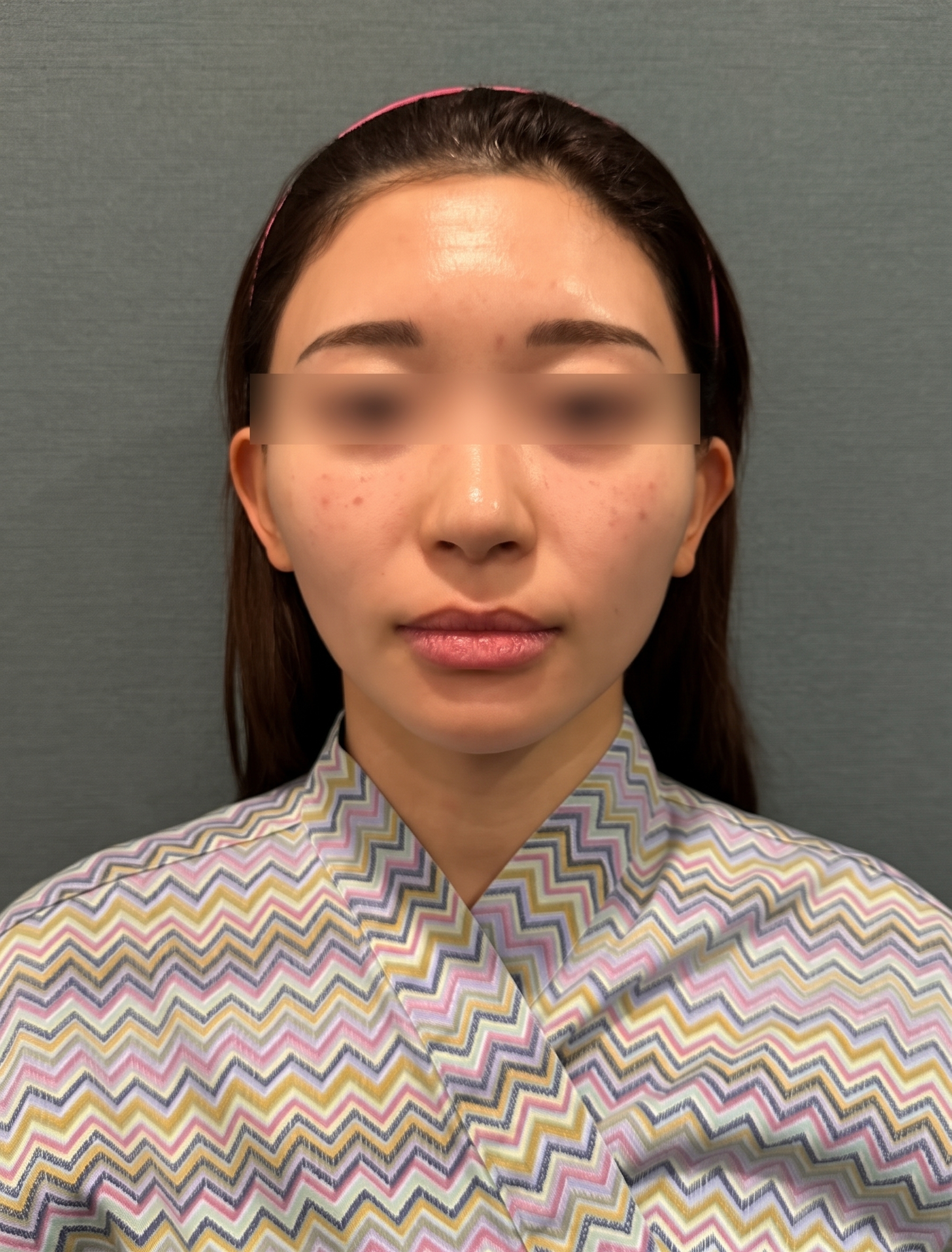 糸リフトの副作用、腫れや内出血だけだと思っていませんか?施術前に知っておくべきこと 사진 9