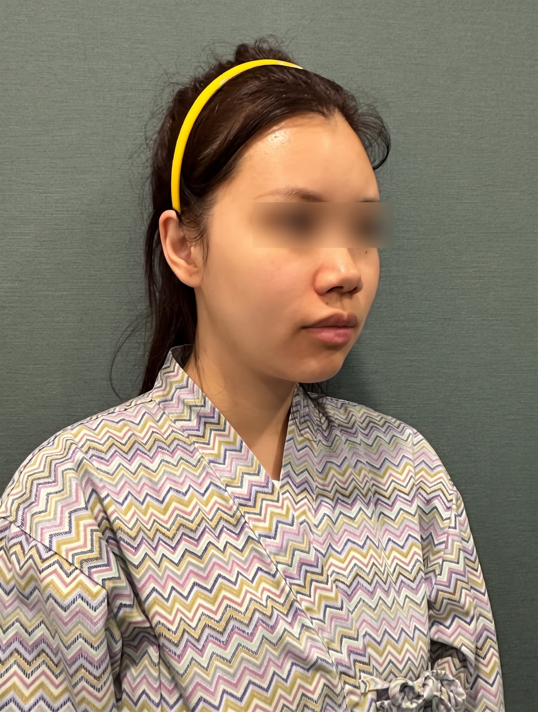 糸リフトの持続期間、1回の施術でどのくらい長持ちする? 사진 9