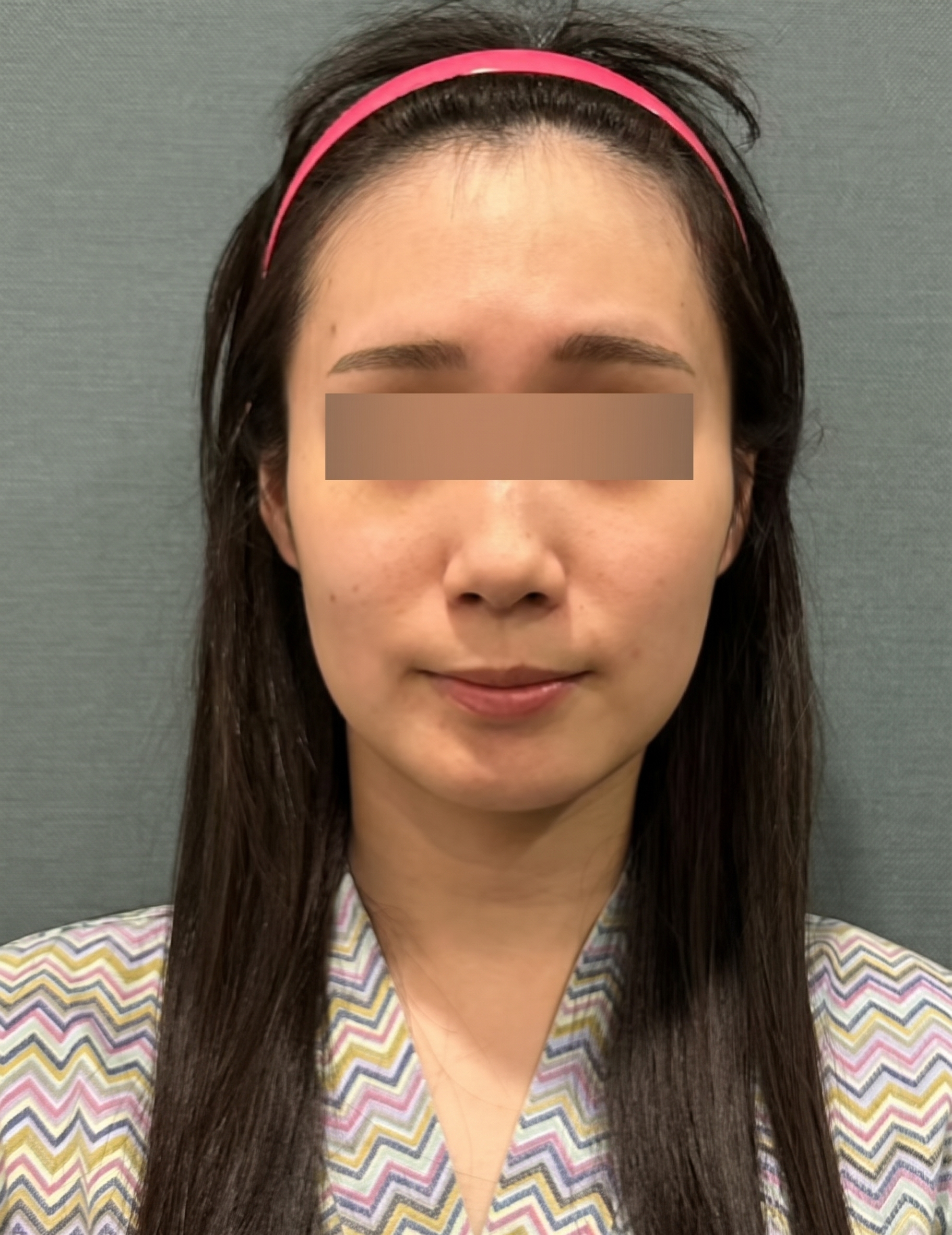 糸リフトの持続期間、1回の施術でどのくらい長持ちする? 사진 4
