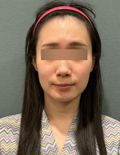 실리프팅유지기간, 한 번 받으면 얼마나 오래갈까? 사진 4