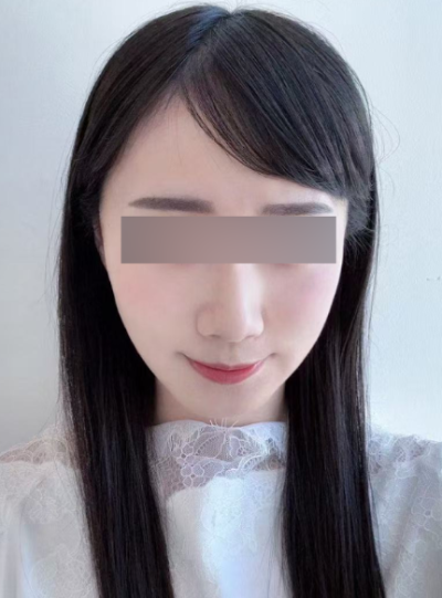 실리프팅유지기간, 한 번 받으면 얼마나 오래갈까? 사진 5
