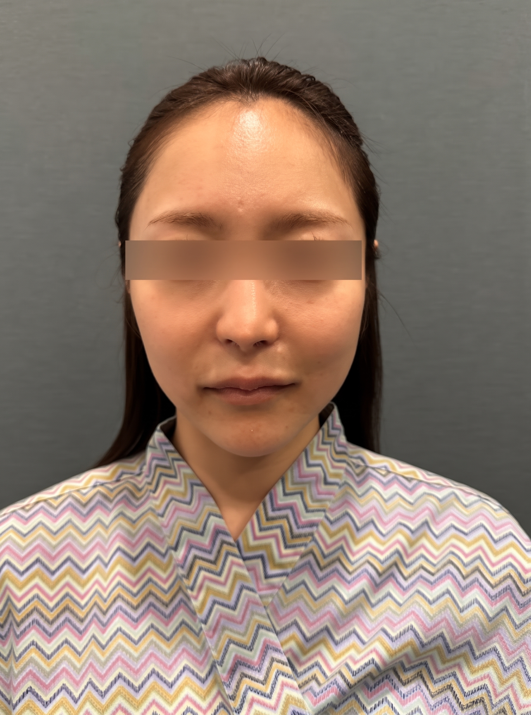 埋線拉提維持時間，做一次究竟能維持多久？ 사진 6