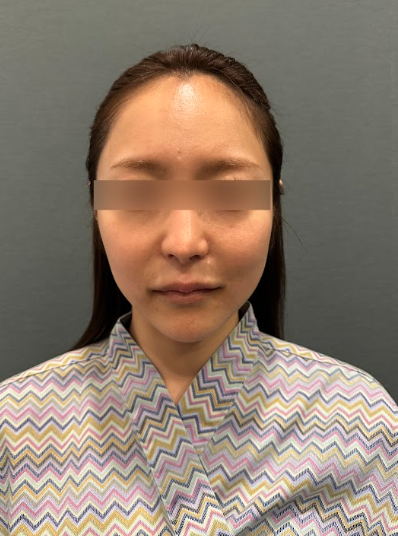 실리프팅유지기간, 한 번 받으면 얼마나 오래갈까? 사진 6