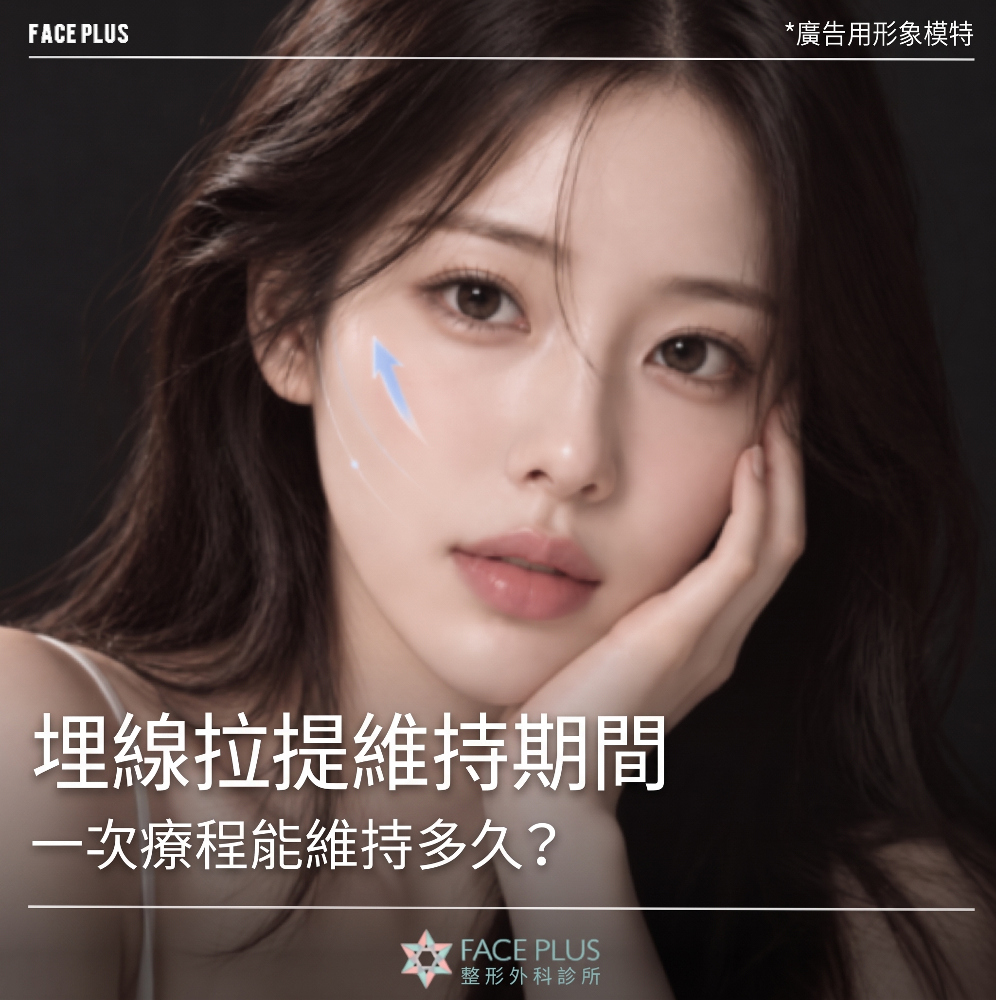 埋線拉提維持時間，做一次究竟能維持多久？