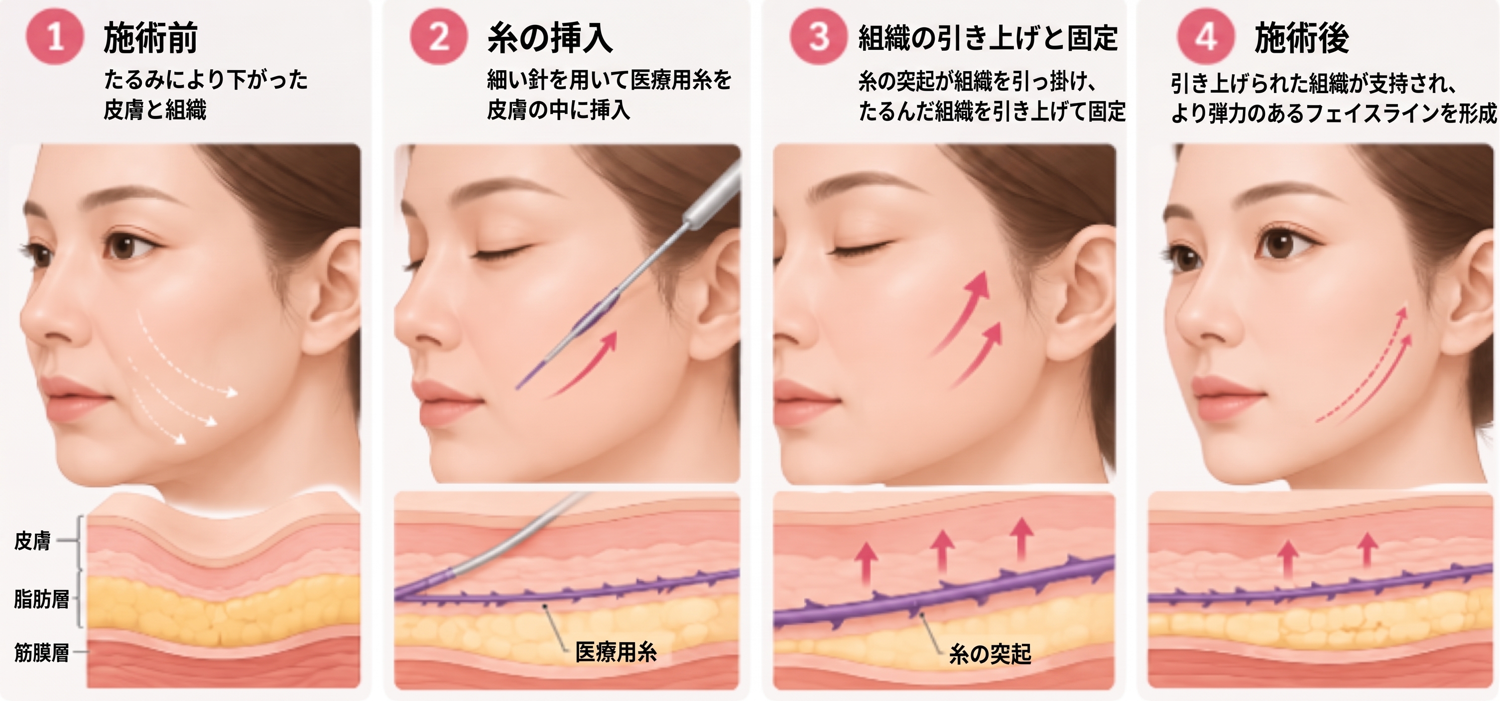 糸リフトの持続期間、1回の施術でどのくらい長持ちする? 사진 3