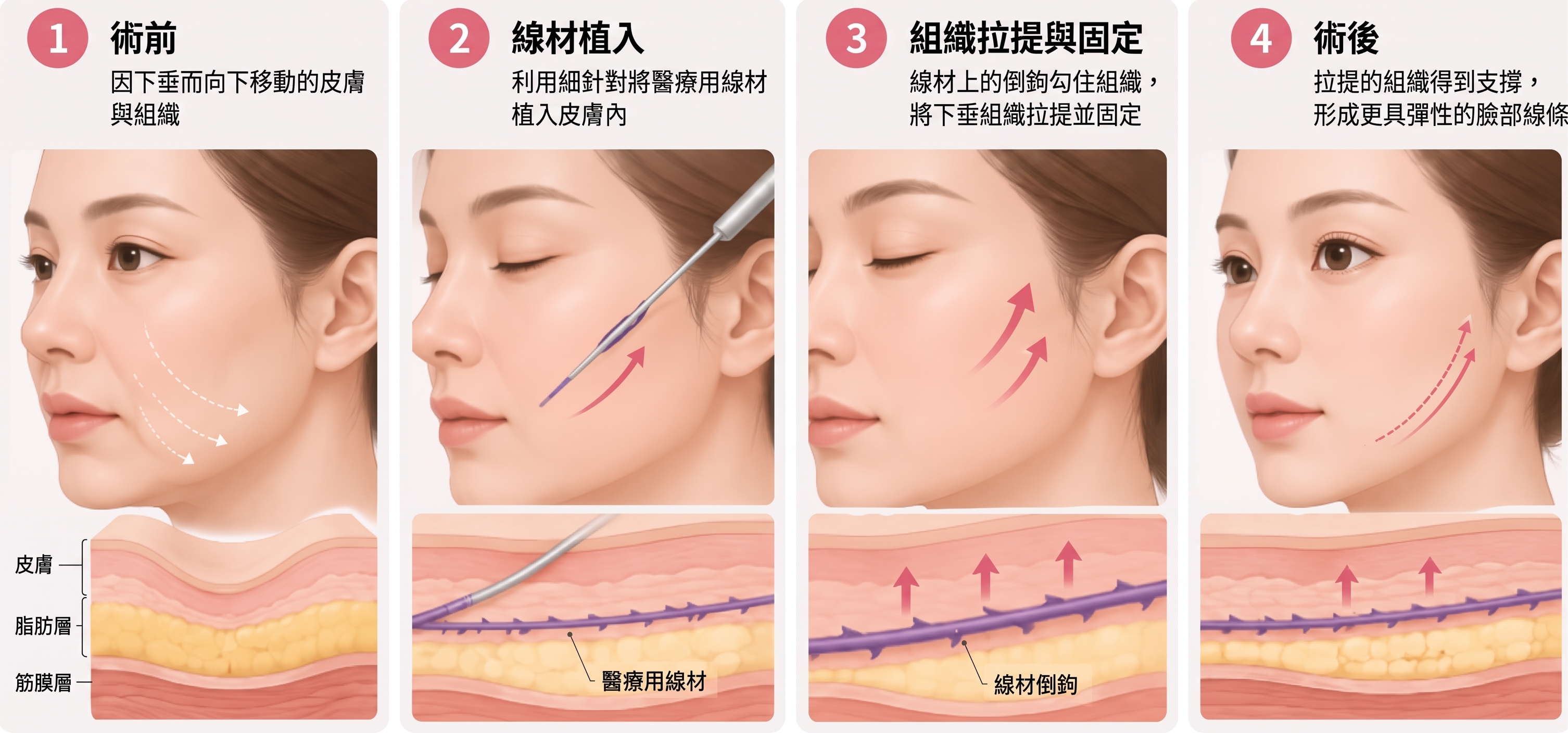 埋線拉提維持時間，做一次究竟能維持多久？ 사진 3