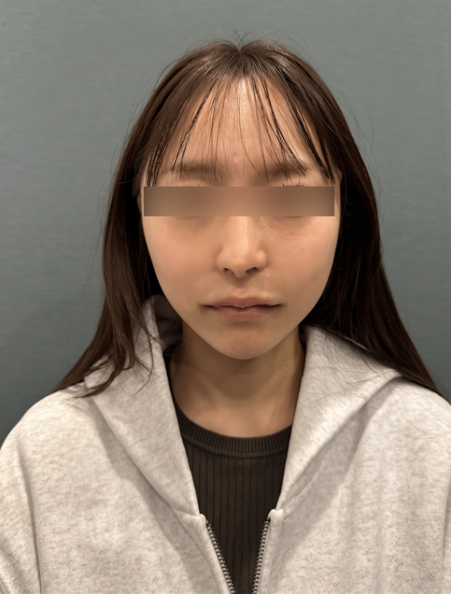 糸リフトの持続期間、1回の施術でどのくらい長持ちする? 사진 7