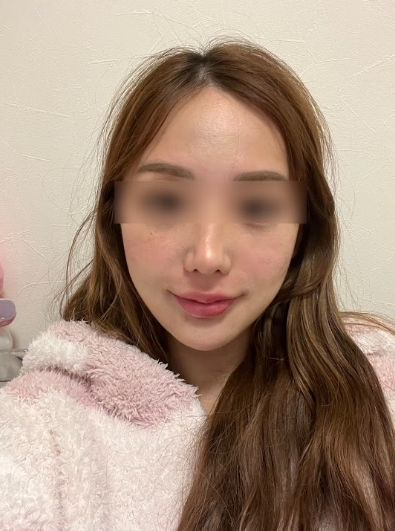 실리프팅 후 붓기 / 멍 / 회복기간, 언제쯤 자연스러워질까? 사진 9