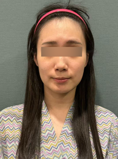 실리프팅 4줄 / 8줄 / 12줄, 많이 넣을수록 효과가 좋을까? 사진 6