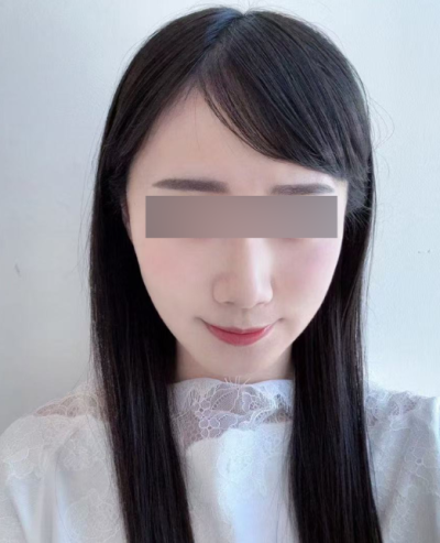 실리프팅 4줄 / 8줄 / 12줄, 많이 넣을수록 효과가 좋을까? 사진 7